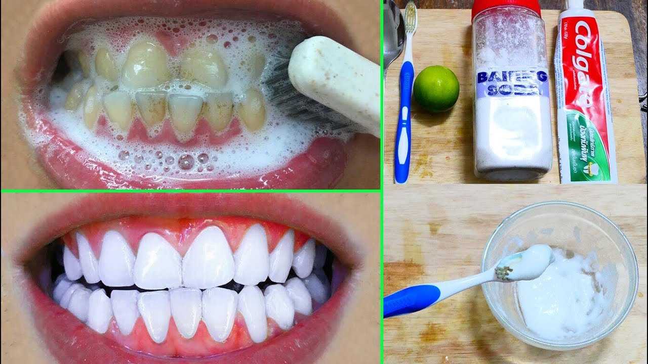 Подготовка к отбеливанию зубов