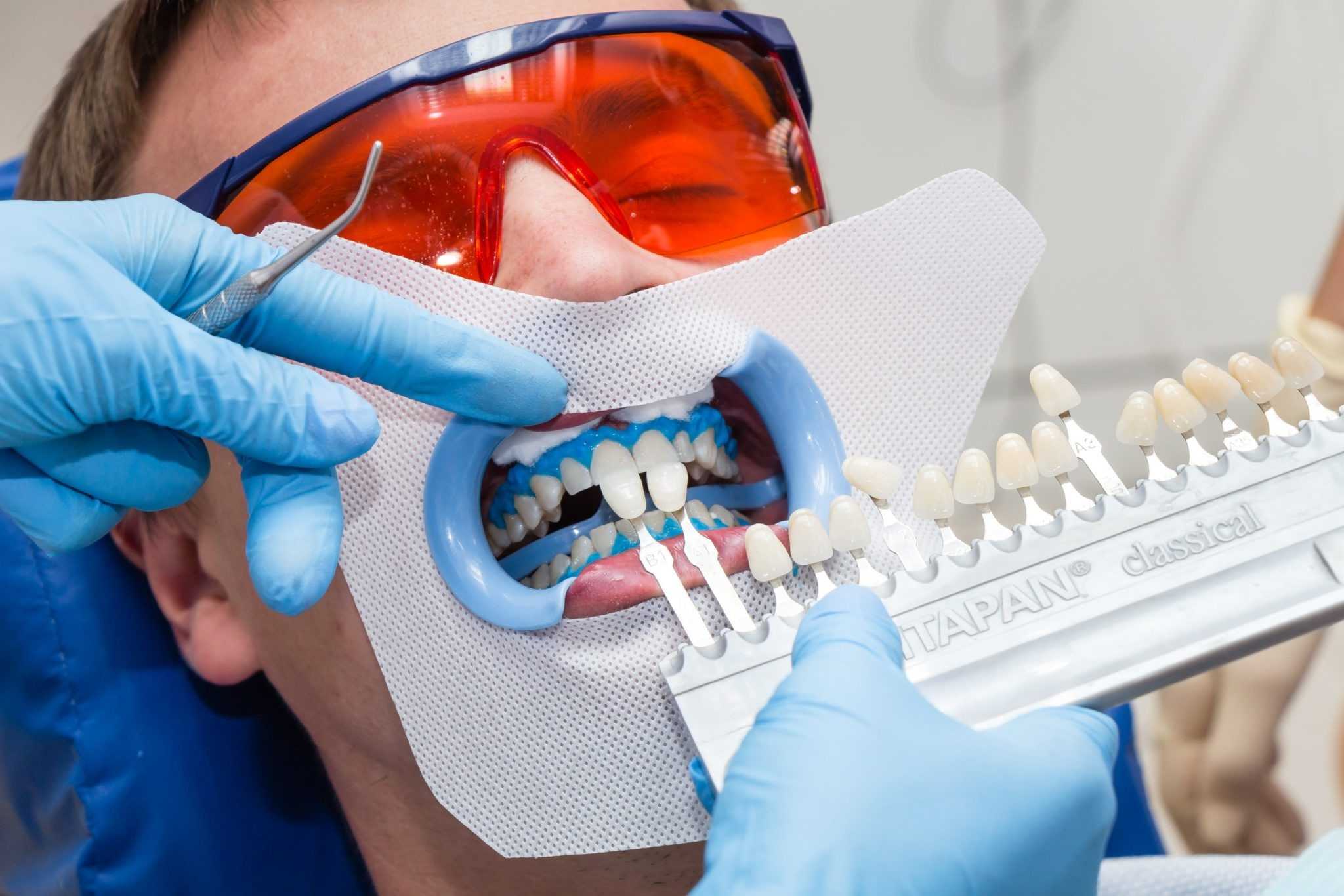 Что влияет на цвет зубной эмали Попробуем разобраться, есть ли эффективный способ отбеливания зубов в домашних условиях