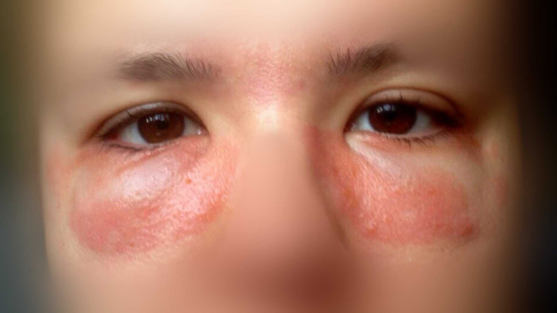 Аллергия на пыль: причины, симптомы, лечение | энтеросгель