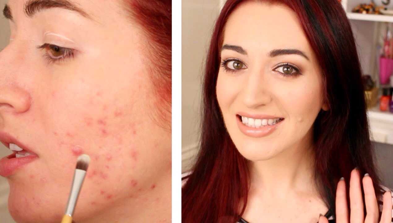 Как с помощью макияжа скрыть проблемные дефекты на лице Советы о том, как замазать прыщи тональным кремом Необходимые процедуры для проблемной кожи