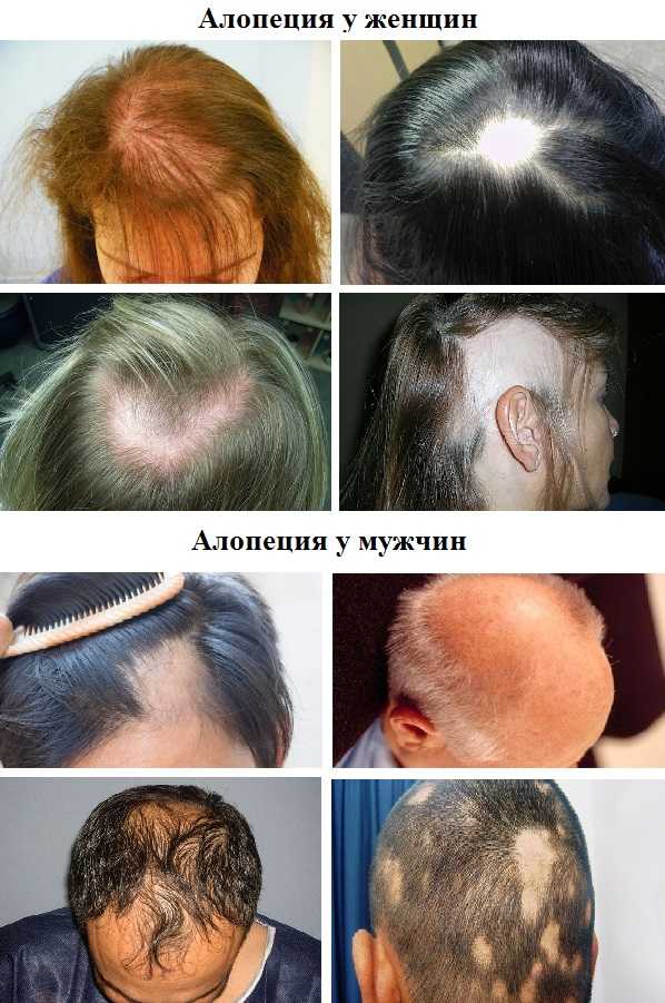 Маски от выпадения волос в домашних условиях: рецепты, советы