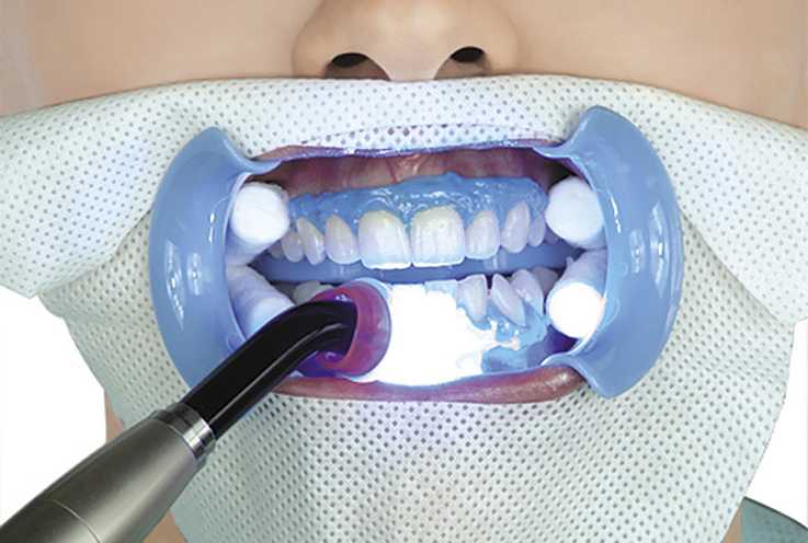 Вредно ли отбеливание зубов – статьи стоматологической клиники «доктор мартин»