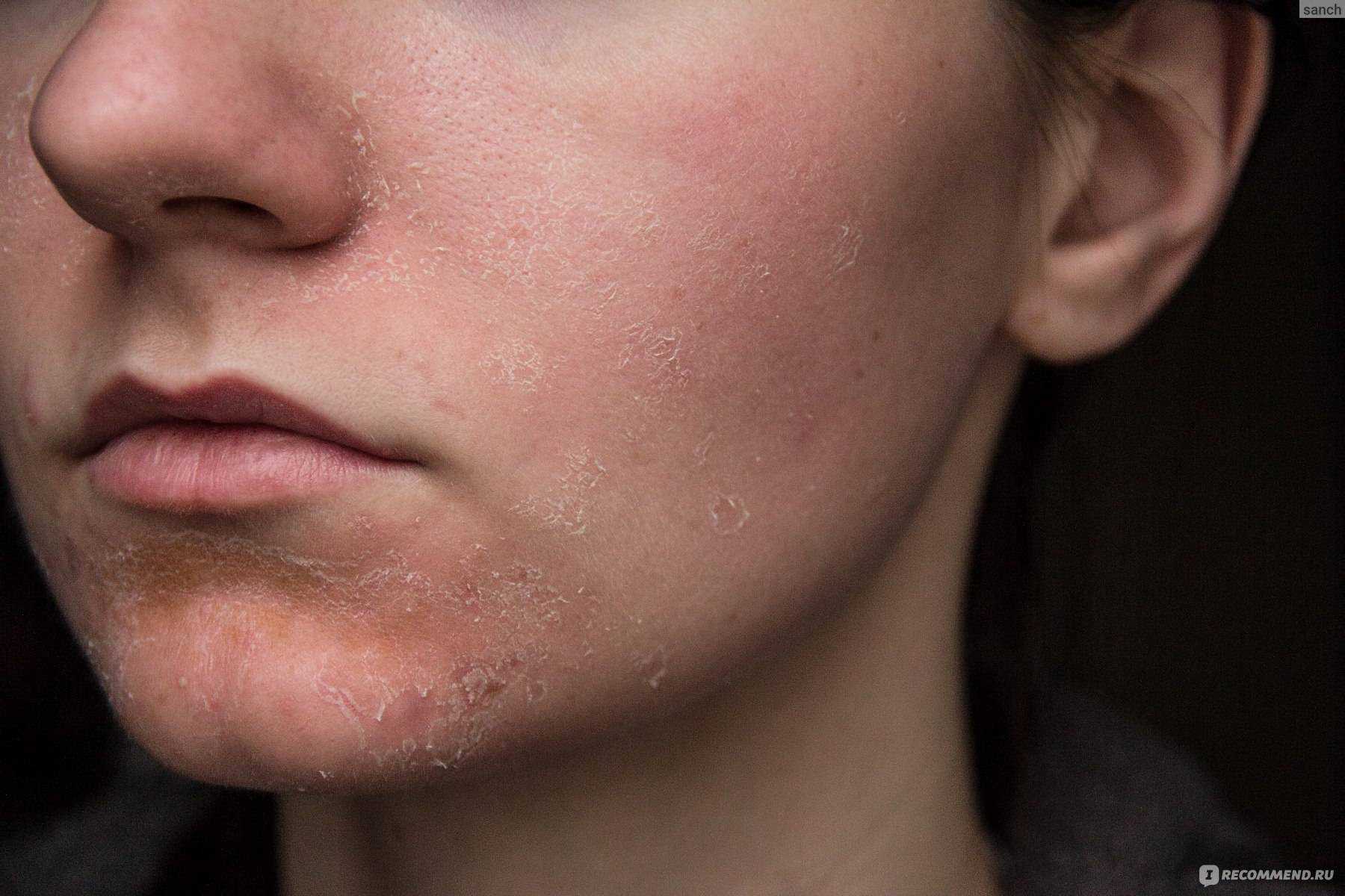 Уход за сухой кожей лица: особенности и основные правила | ceramed