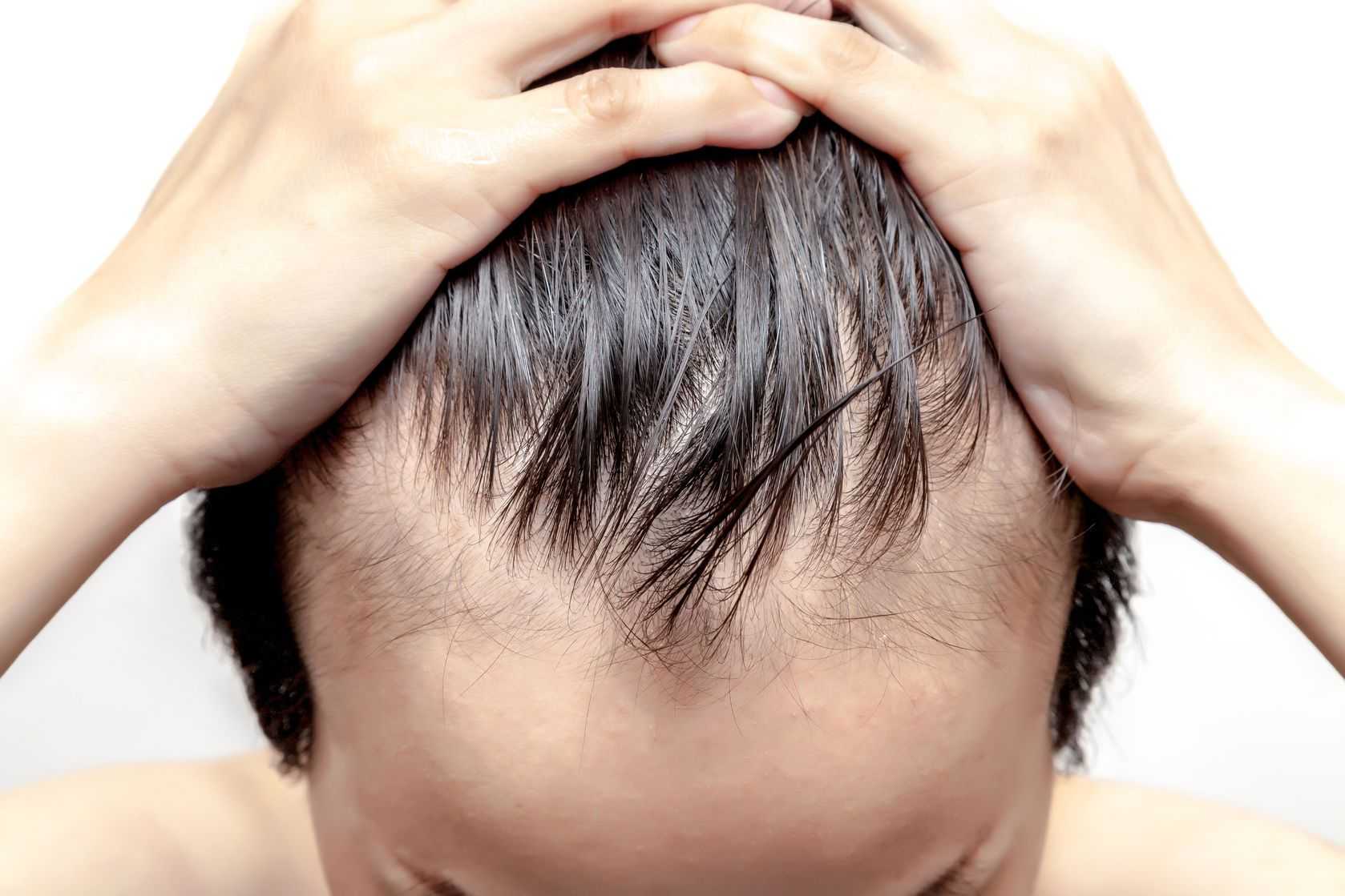 После коронавируса выпадают волосы - что делать и как остановить выпадение после ковида