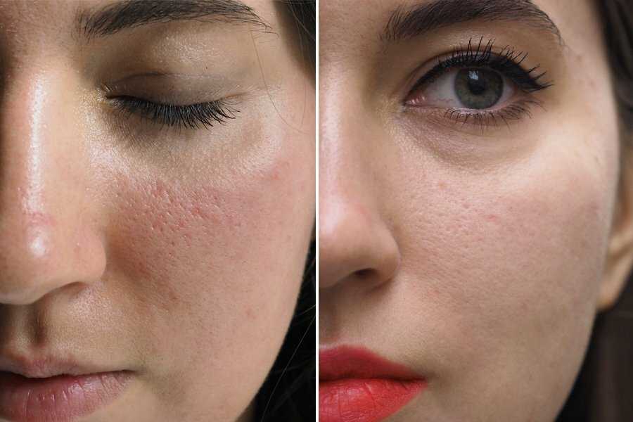Поры на лице – как очистить и сохранить чистоту кожи? [100% эффект]