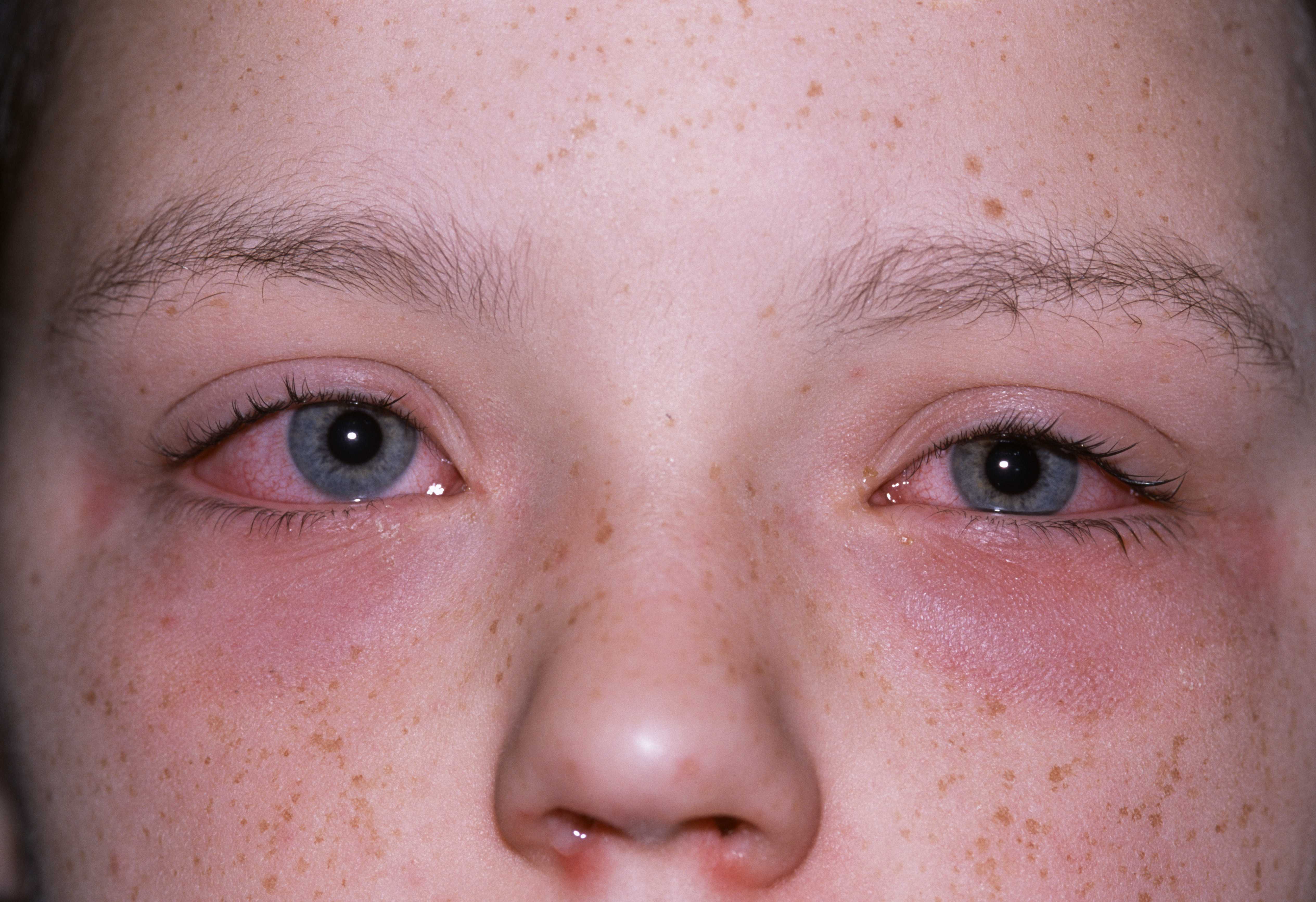 Аллергия: что это, почему возникает и можно ли избавиться навсегда | рбк тренды
