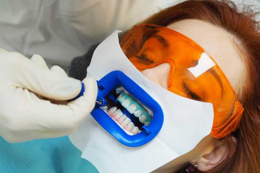 Как безопасно отбелить зубы — стоматология комфорта