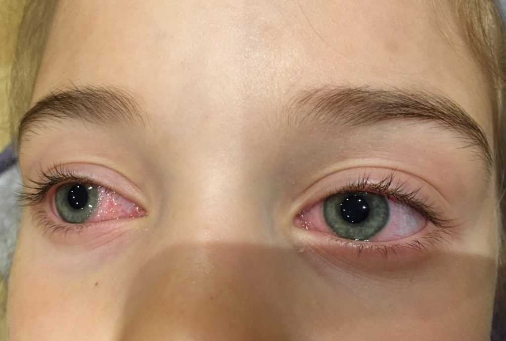 Почему может возникать аллергия на тушь, как вовремя обнаружить симптомы Правила лечения воспаления, народные рецепты и профилактика аллергии