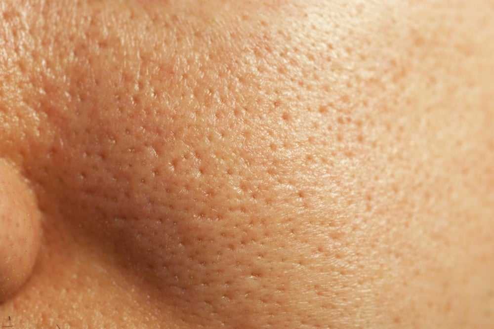 Поры на лице – как очистить и преобразить кожу? [100% работает]
