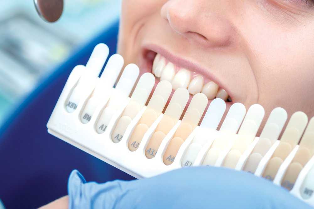 определение отбеливание зубов