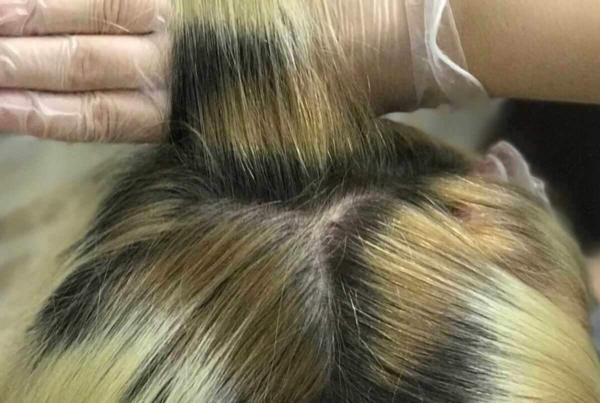Лечение выпадения волос после окрашивания - клиника ренео.