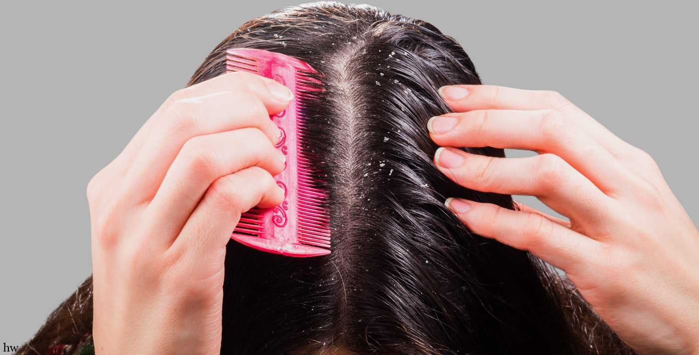 Себорейное выпадение волос: причины, лечение, профилактика