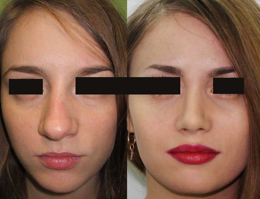 Контуринг носа: пошаговая инструкция c видео и 34 фото