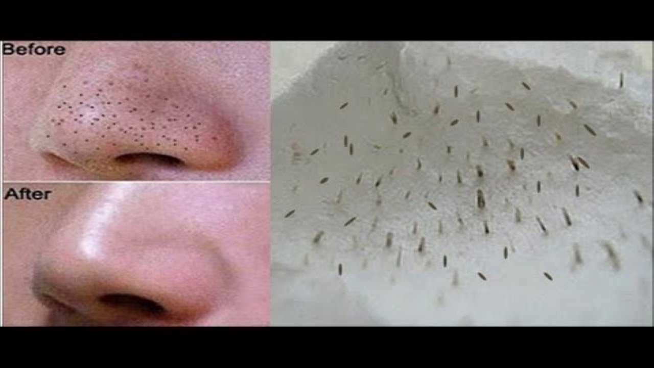 Топ-15 методов как избавиться от черных точек в домашних условиях на лице и носу, отзывы