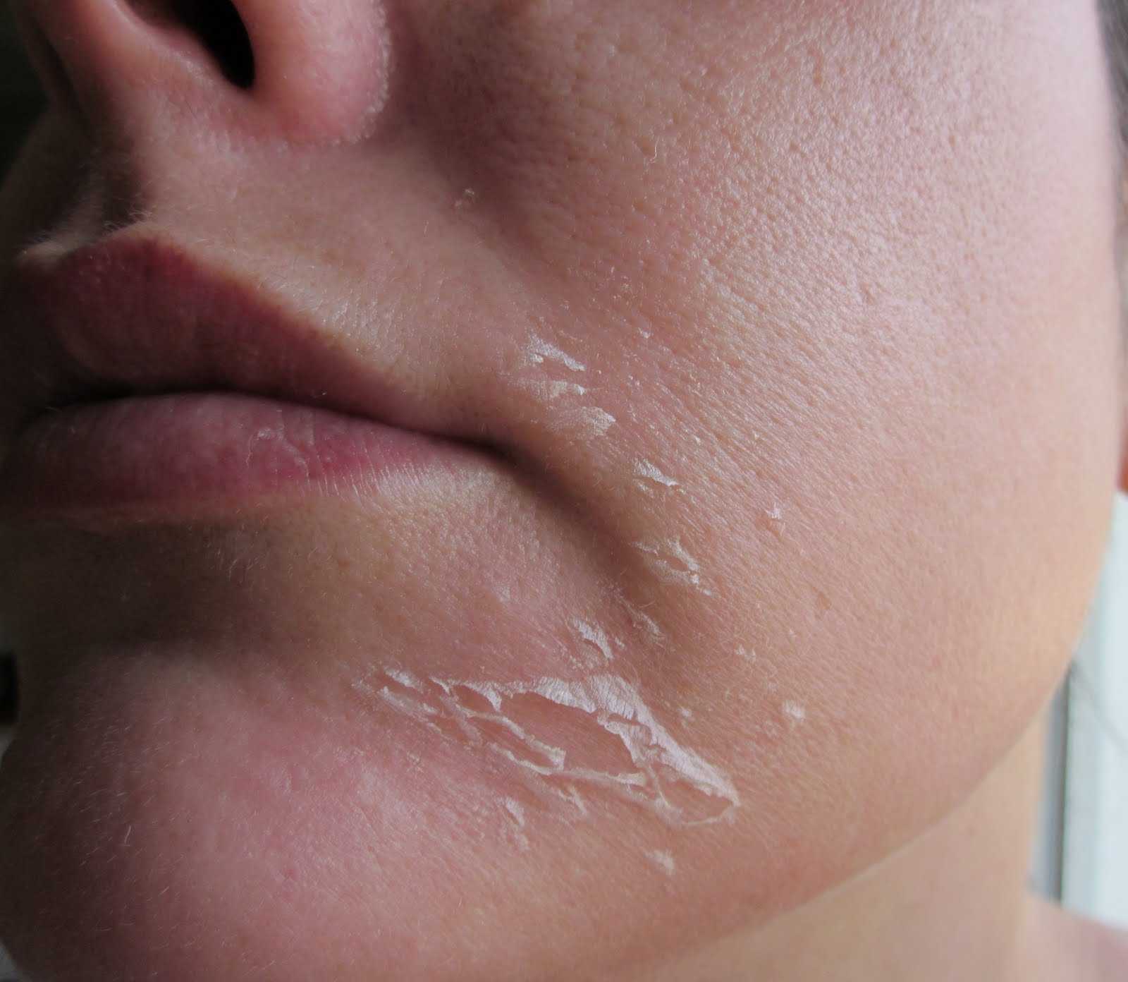 Как ухаживать за кожей после пилинга | лица