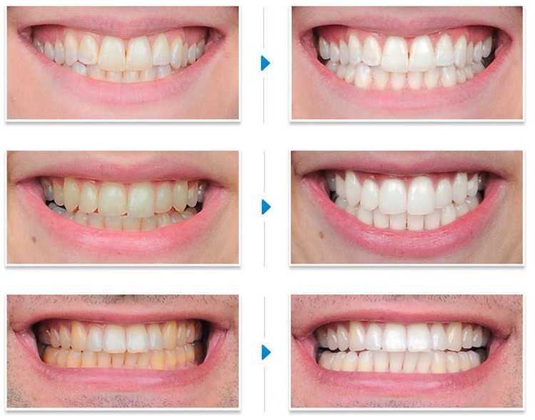 Отбеливание зубов после процедуры отбеливание протезов зубов таблетки корега