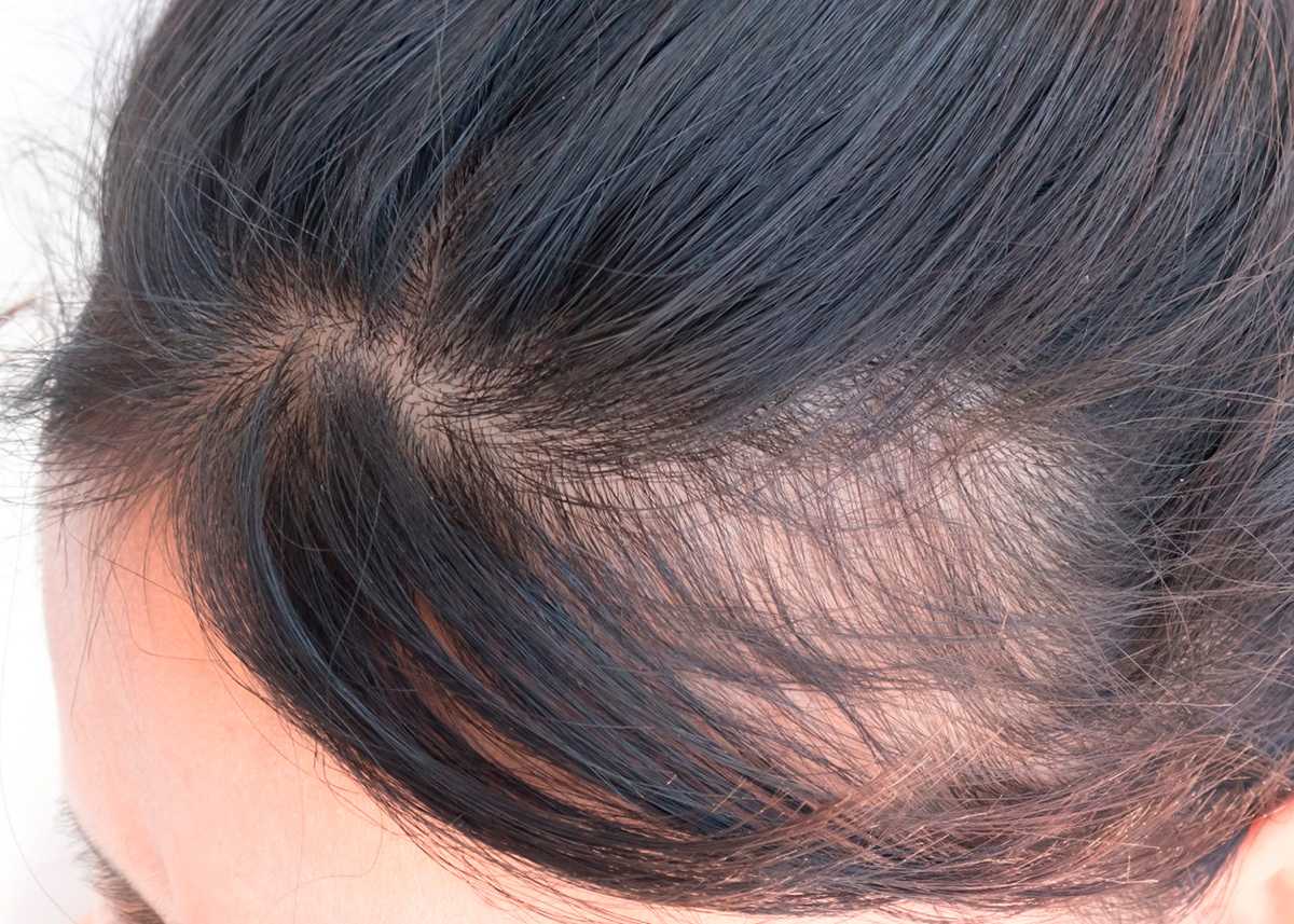 После коронавируса сильно выпадают волосы: что делать с выпадением и как восстановиться: чем лечить, укрепить и остановить и процесс у женщин и мужчин из-за прививки от ковида (короны) – причины и лечение для восстановления