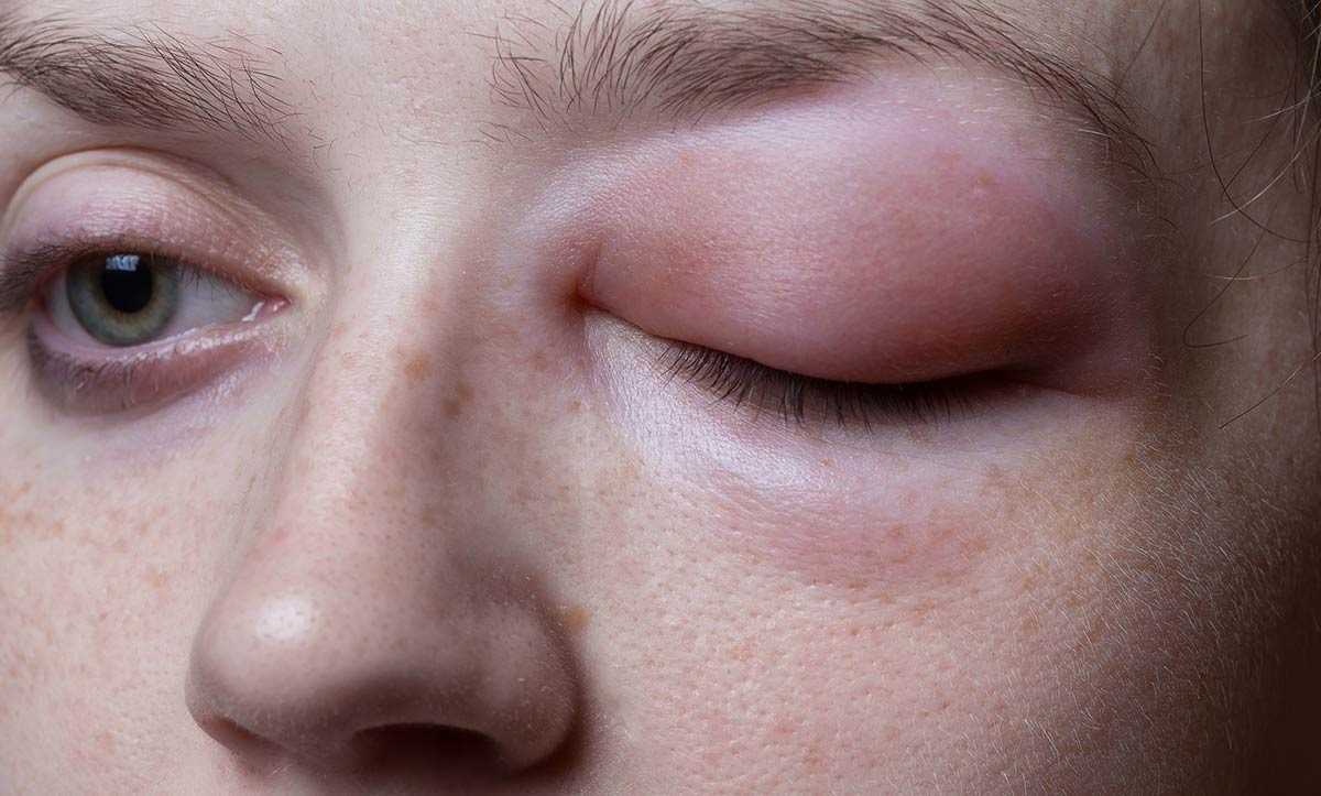 Аллергия на бытовую химию | энтеросгель