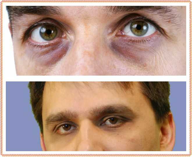 Как правильно ухаживать за кожей вокруг глаз: уход за кожей век