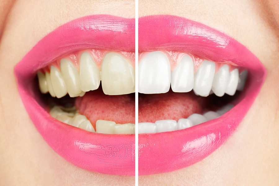 Как отбелить зубы в клинике? виды отбеливания зубов - плюсы и минусы