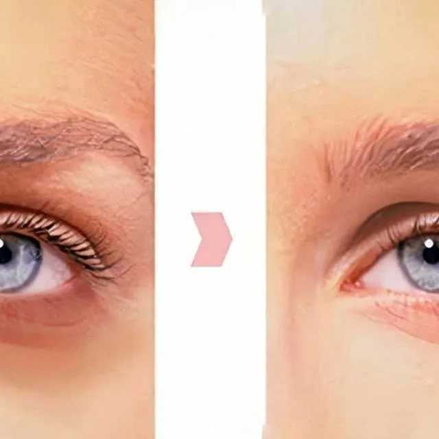 Топ процедур для кожи вокруг глаз