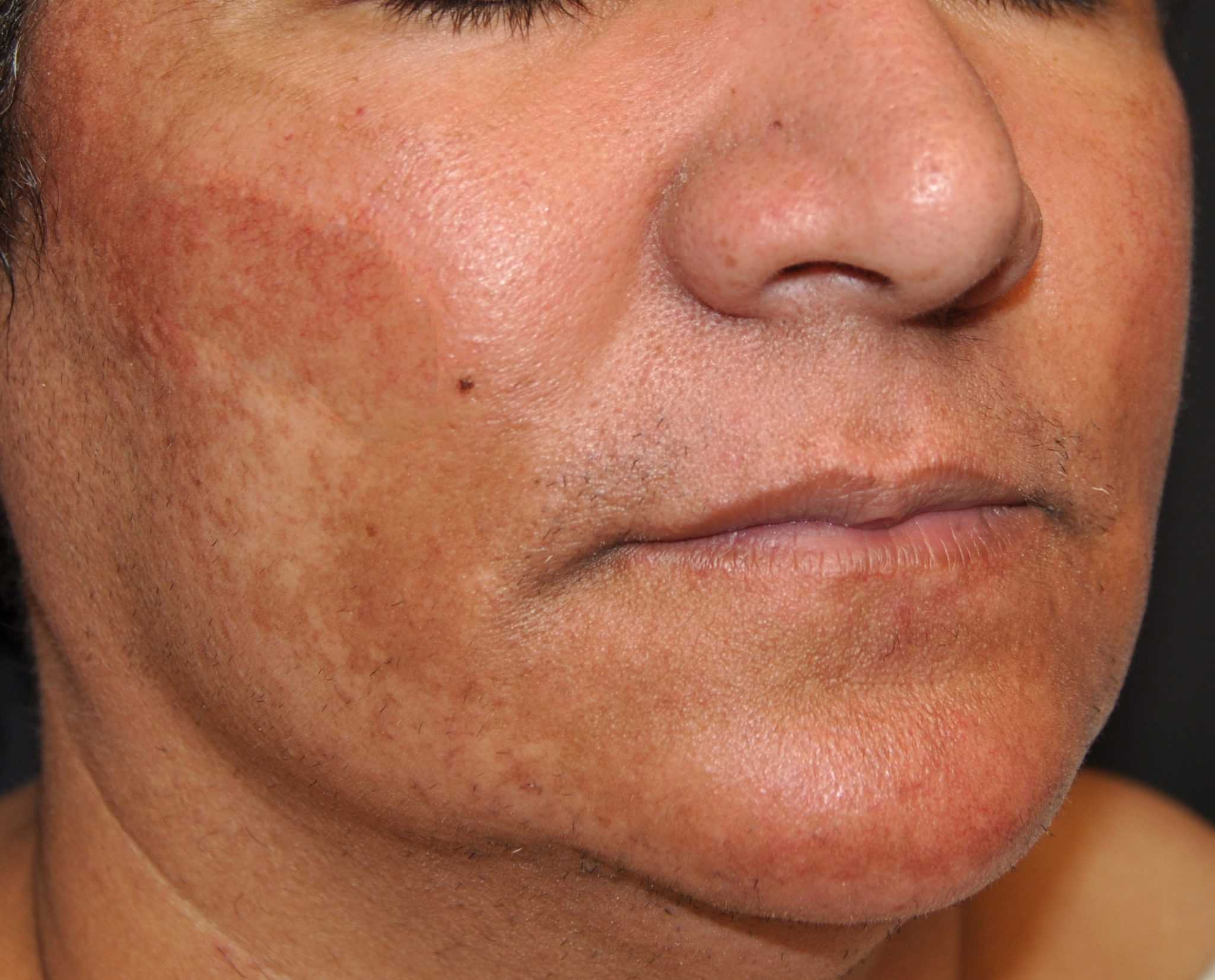 Мелазма на лице: лазерное лечение | атлантик