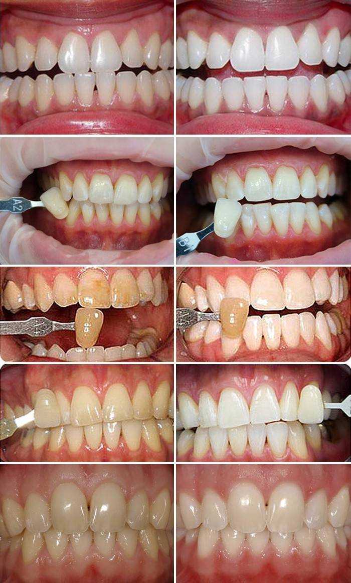Не вредит ли отбеливание зубами ингалятор муссон 3 инструкция по применению